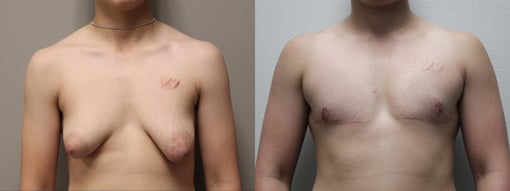 female to male transition before and after photos by kryger institute of plastic surgery in thousand oaks ca