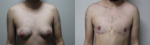 female to male transition before and after photos by kryger institute of plastic surgery in thousand oaks ca