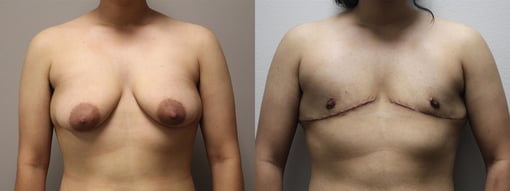 female to male transition before and after photos by kryger institute of plastic surgery in thousand oaks ca