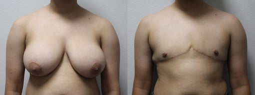 female to male transition before and after photos by kryger institute of plastic surgery in thousand oaks ca