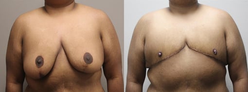 female to male transition before and after photos by kryger institute of plastic surgery in thousand oaks ca