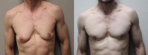 female to male transition before and after photos by kryger institute of plastic surgery in thousand oaks ca