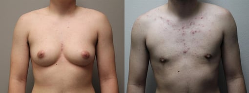 female to male transition before and after photos by kryger institute of plastic surgery in thousand oaks ca