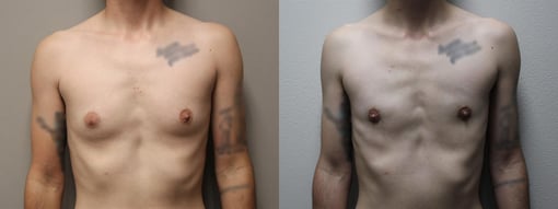 female to male transition before and after photos by kryger institute of plastic surgery in thousand oaks ca