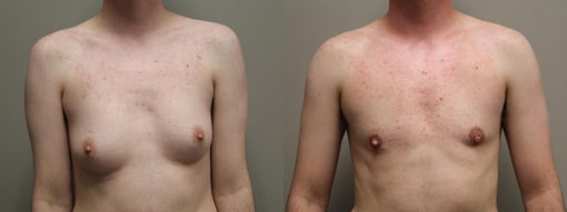 female to male transition before and after photos by kryger institute of plastic surgery in thousand oaks ca
