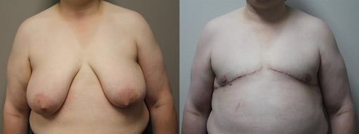 female to male transition before and after photos by kryger institute of plastic surgery in thousand oaks ca