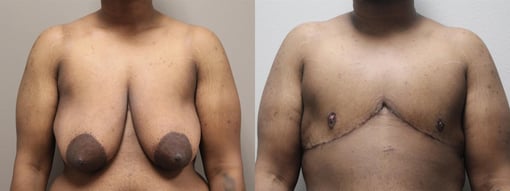 female to male transition before and after photos by kryger institute of plastic surgery in thousand oaks ca