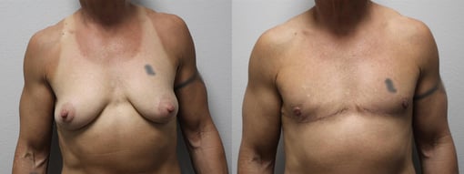 female to male transition before and after photos by kryger institute of plastic surgery in thousand oaks ca