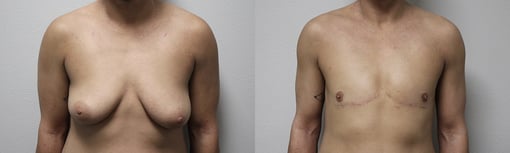 female to male transition before and after photos by kryger institute of plastic surgery in thousand oaks ca