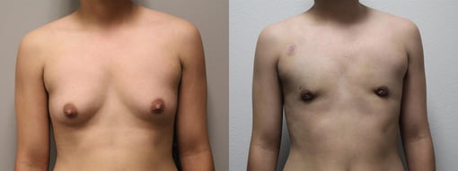 female to male transition before and after photos by kryger institute of plastic surgery in thousand oaks ca