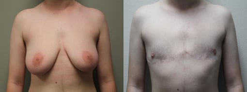female to male transition before and after photos by kryger institute of plastic surgery in thousand oaks ca