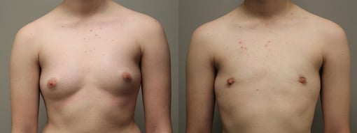 female to male transition before and after photos by kryger institute of plastic surgery in thousand oaks ca