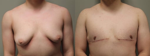 female to male transition before and after photos by kryger institute of plastic surgery in thousand oaks ca