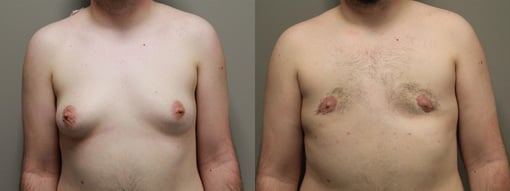 female to male transition before and after photos by kryger institute of plastic surgery in thousand oaks ca