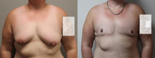female to male transition before and after photos by kryger institute of plastic surgery in thousand oaks ca