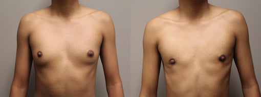 female to male transition before and after photos by kryger institute of plastic surgery in thousand oaks ca