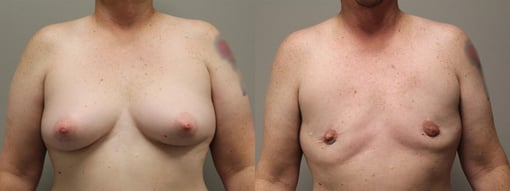 female to male transition before and after photos by kryger institute of plastic surgery in thousand oaks ca