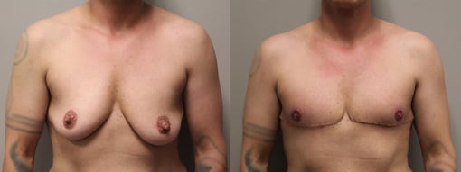female to male transition before and after photos by kryger institute of plastic surgery in thousand oaks ca