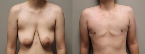 female to male transition before and after photos by kryger institute of plastic surgery in thousand oaks ca