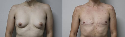 female to male transition before and after photos by kryger institute of plastic surgery in thousand oaks ca