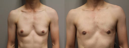female to male transition before and after photos by kryger institute of plastic surgery in thousand oaks ca