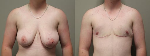 female to male transition before and after photos by kryger institute of plastic surgery in thousand oaks ca