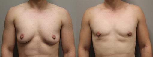 female to male transition before and after photos by kryger institute of plastic surgery in thousand oaks ca