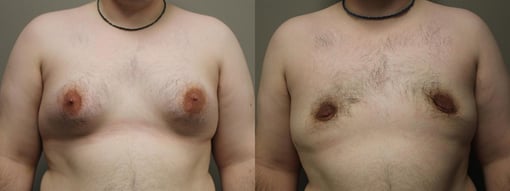 female to male transition before and after photos by kryger institute of plastic surgery in thousand oaks ca