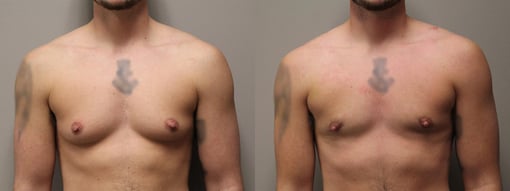 female to male transition before and after photos by kryger institute of plastic surgery in thousand oaks ca