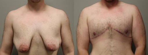 female to male transition before and after photos by kryger institute of plastic surgery in thousand oaks ca