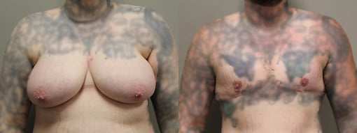 female to male transition before and after photos by kryger institute of plastic surgery in thousand oaks ca