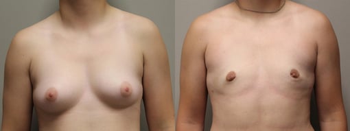 female to male transition before and after photos by kryger institute of plastic surgery in thousand oaks ca