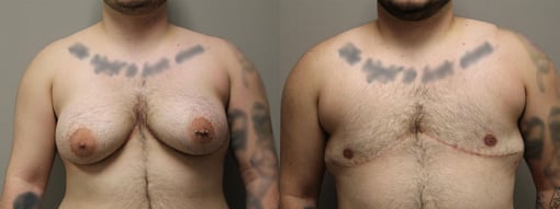female to male transition before and after photos by kryger institute of plastic surgery in thousand oaks ca