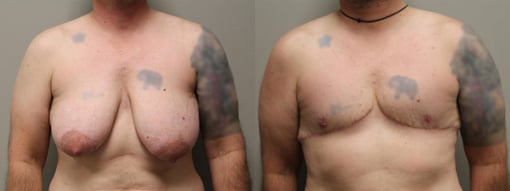 female to male transition before and after photos by kryger institute of plastic surgery in thousand oaks ca