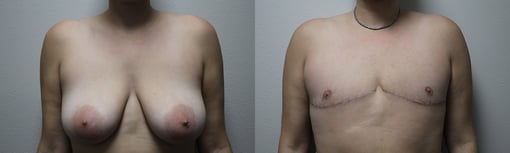 female to male transition before and after photos by kryger institute of plastic surgery in thousand oaks ca