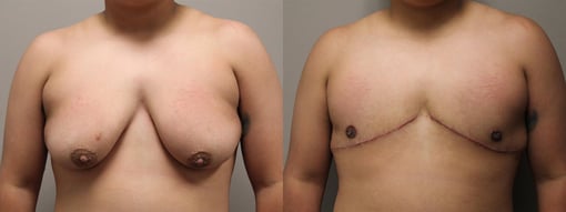 female to male transition before and after photos by kryger institute of plastic surgery in thousand oaks ca