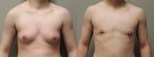 female to male transition before and after photos by kryger institute of plastic surgery in thousand oaks ca
