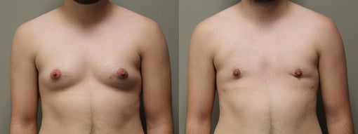 female to male transition before and after photos by kryger institute of plastic surgery in thousand oaks ca