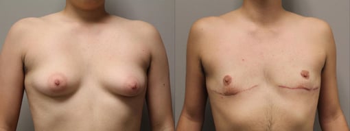 female to male transition before and after photos by kryger institute of plastic surgery in thousand oaks ca