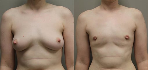 female to male transition before and after photos by kryger institute of plastic surgery in thousand oaks ca