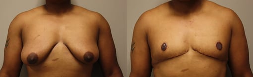 female to male transition before and after photos by kryger institute of plastic surgery in thousand oaks ca