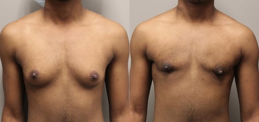female to male transition before and after photos by kryger institute of plastic surgery in thousand oaks ca