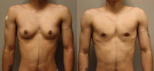 female to male transition before and after photos by kryger institute of plastic surgery in thousand oaks ca