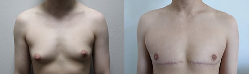 female to male transition before and after photos by kryger institute of plastic surgery in thousand oaks ca
