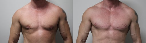 female to male transition before and after photos by kryger institute of plastic surgery in thousand oaks ca