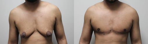 female to male transition before and after photos by kryger institute of plastic surgery in thousand oaks ca