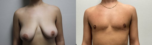 female to male transition before and after photos by kryger institute of plastic surgery in thousand oaks ca