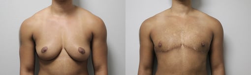 female to male transition before and after photos by kryger institute of plastic surgery in thousand oaks ca