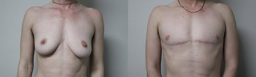 female to male transition before and after photos by kryger institute of plastic surgery in thousand oaks ca