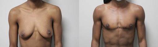 female to male transition before and after photos by kryger institute of plastic surgery in thousand oaks ca